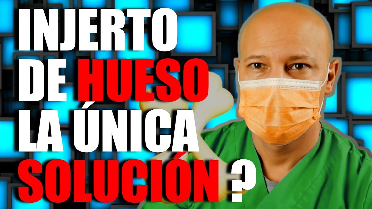 POCO HUESO INJERTO de HUESO y otras ALTERNATIVAS!