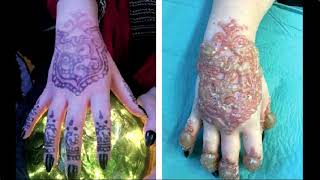 Henna Dermatitis - Allergic Contact Dermatitis