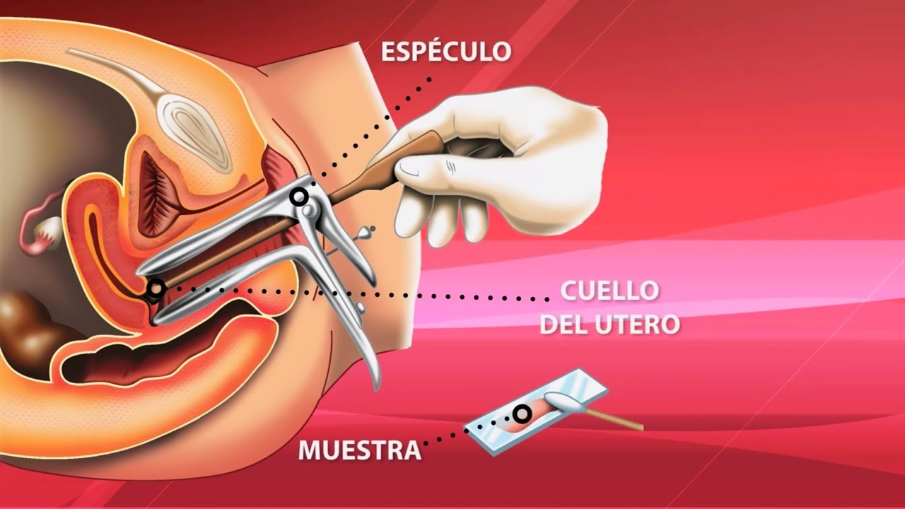 ▶️ ¿A partir de cuál edad se debe hacer el Papanicolaou?