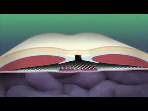 Offene, minimal-invasive Hernienreparation mit Netz (MILOS, sublay) - Prinzip