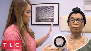 Removing Moles with Liquid Nitrogen | Dr. Pimple Popper