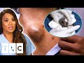 Dr Sandra Lee Removes Larry The Lump From Man’s Chest | Dr Pimple Popper | UNCENSORED | 18+