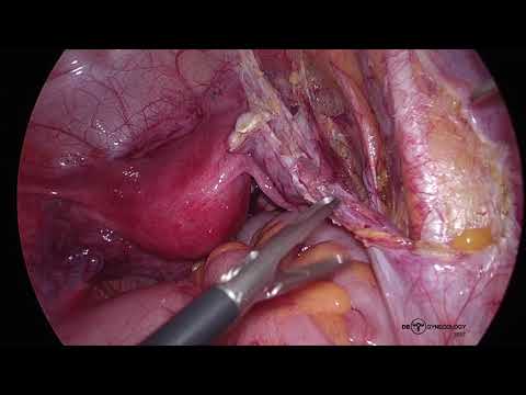 Cervical Cancer: Laparoscopic Pelvic Lymphodenectomy and Sentinel LN dissection