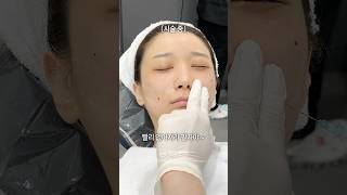 팔자주름 없애고 5년 더 어려지기 😖