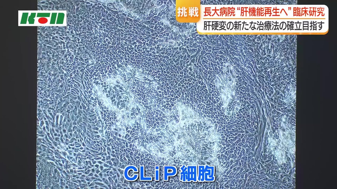 新たな治療法　長崎大学病院「CLiP細胞を用いた肝臓再生医療」の臨床研究を開始　５～１０年後の実用化目指す