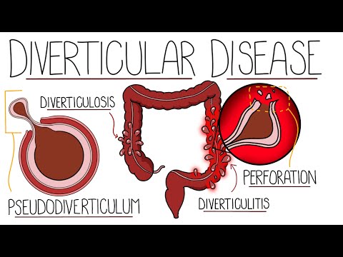 Acute Pancreatitis Causes Signs Symptoms Pathophysiology Diagnosis