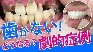 【セラミック矯正】全て見せます！ひどい虫歯と歯周病…治療とセラミックで長持ちする美しい歯へサムネイル