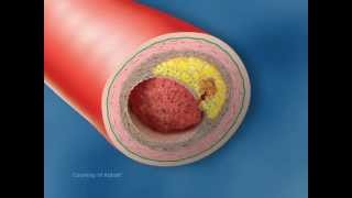 Vulnerable Plaque Rupture - Medical Animation by Watermark