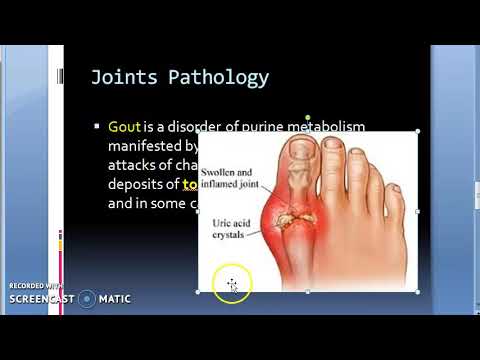 Pathology 859 Joint Pathology,Osteo Arthritis,Rheumatoid,Gout,Synovitis,Bursitis