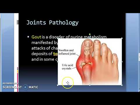 A lábak ízületeinek fájdalma: okok, tünetek, diagnózis, kezelés - Arthrosis 