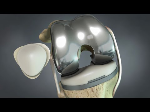 Animação em 3D de uma prótese total de joelho