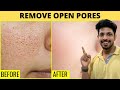 Remove Open Pores Very Fast (Just 15mins Daily)