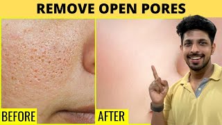 Remove Open Pores Very Fast (Just 15mins Daily)