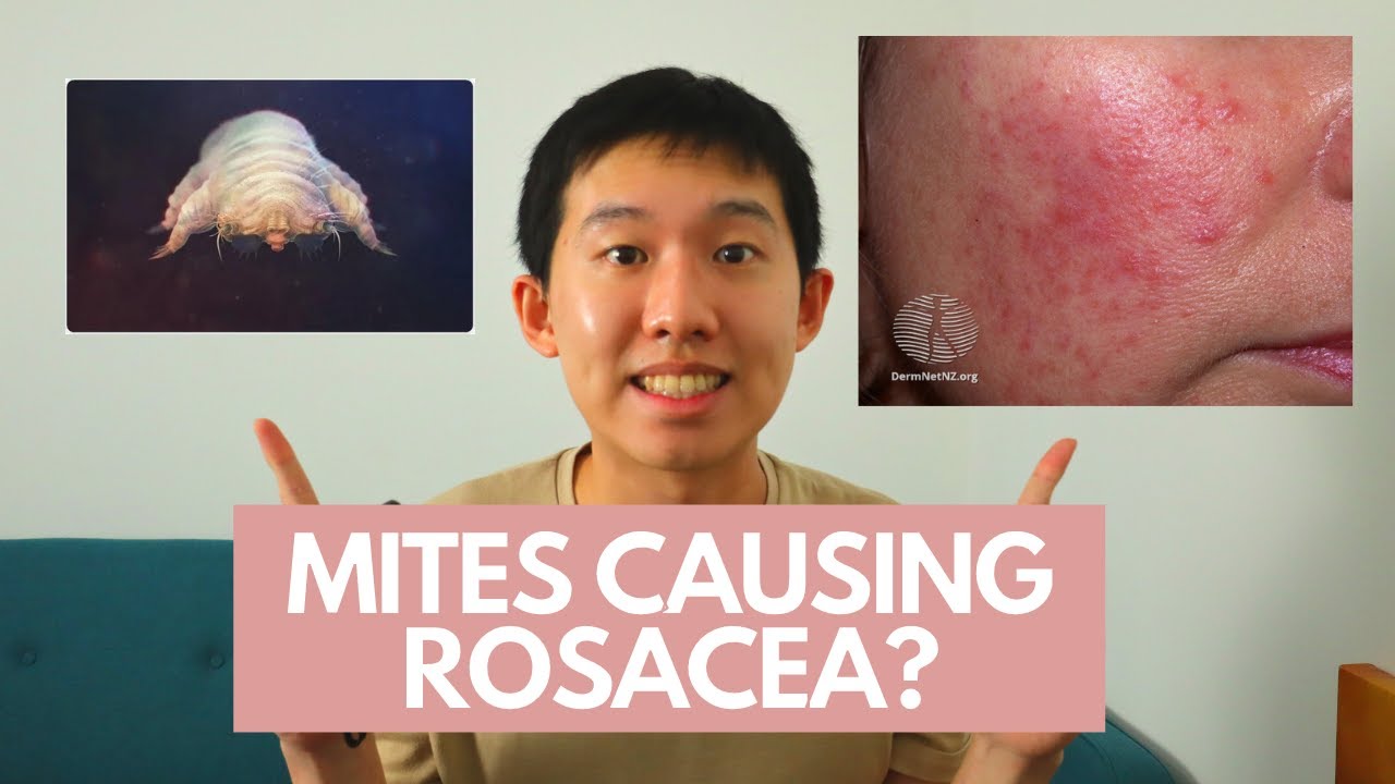 MANAGEMENT OF ROSACEA