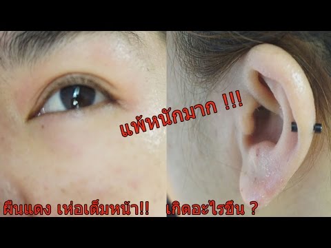 ทะเลเดดซีสำหรับโรคสะเก็ดเงิน Girudoterapija สำหรับโรคสะเก็ดเงิน
