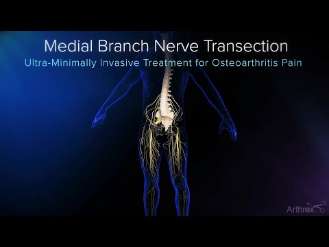 Endoscopic Medial Branch Nerve Transection