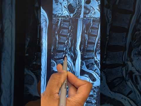 Lumbar Spine slip disc : Endoscopic spine surgery