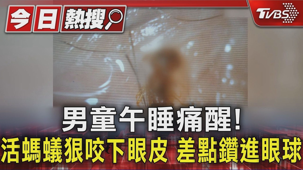 影音/男童午睡痛醒! 活螞蟻狠咬下眼皮 差點鑽進眼球