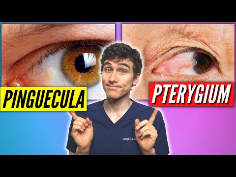 Pinguecula Vs Pterygium (Signs, Symptoms, Treatment)