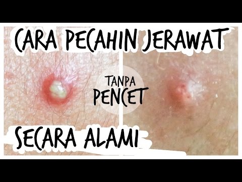 VIDEO Cara Alami Menghilangkan Jerawat Bernanah Terlengkap