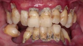 Decontamination previous surgery....Tartrectomía antes de extracciones