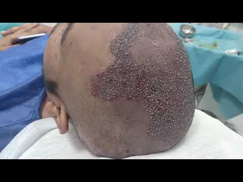 Patient Recovery Case — Video 39 (Gynecomastia)
