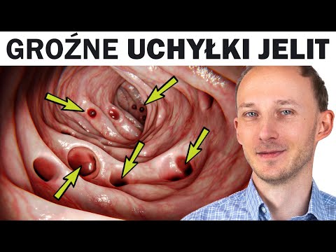 Choruje na to coraz więcej ludzi: UCHYŁKI JELIT i jak im zapobiec