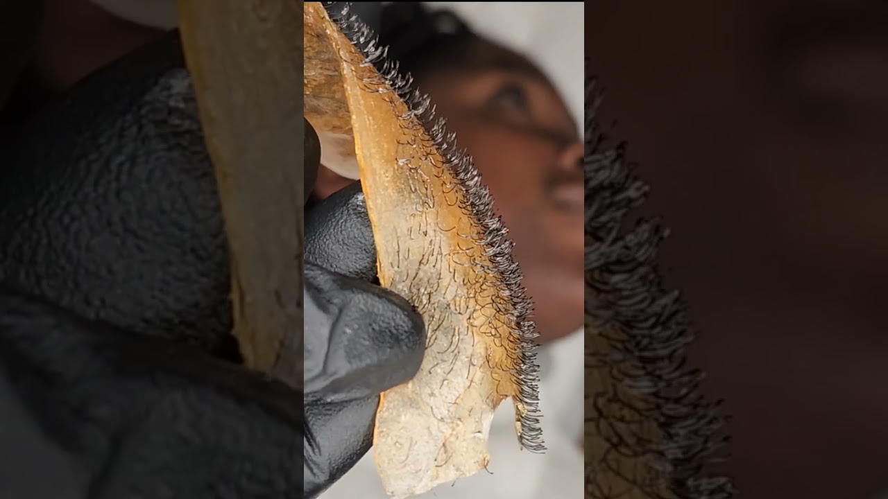 Female Full Beard | One Strip Removal // RECAP