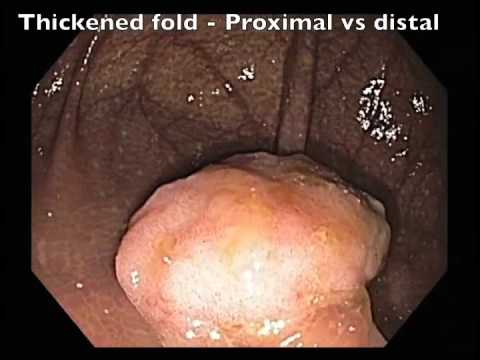 Épaississement du pli intestinal - Signe d'envahissement sous-muqueuse