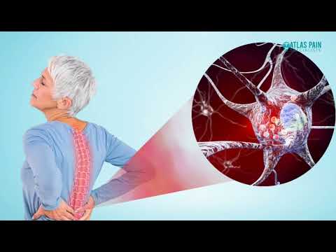What is Nerve Pain - Atlas Pain Specialists