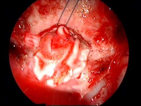 Meningoma - Procedure Of Fascial Patch And Sinus Balloon