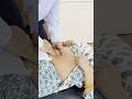Navel Displacement Treatment By Dr Harish Grover Ytshort Feed Trend Shortfeed