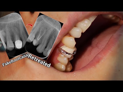 Root Canal Treatment of The Maxillary First Premolar Tooth | A Case of Retreatment