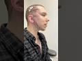 Why I Got A Face Lift Neck Lift At 32 Years Old