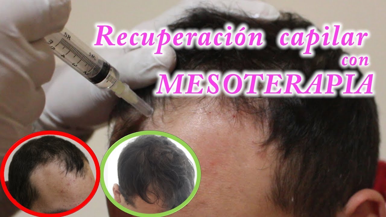 🔥 EL Mejor tratamiento para la caída del pelo - MESOTERAPIA CAPILAR  🔥