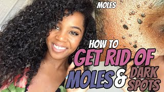 How To Get Rid Of Moles & Dark Spots | Perfect Skin |  Vlogmas Day 13