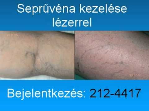 visszér és halolaj kenőcs a varikózus vénákra terhes nők számára