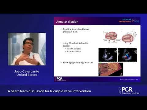 A heart-team discussion for tricuspid valve intervention - PCR London Valves 2021