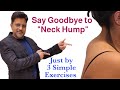 Say Goodbye To Neck Hump Just By Doing 3 Simple Exercises