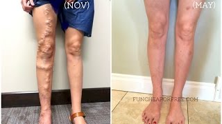 My Varicose Vein Story - All Your Questions Answered!