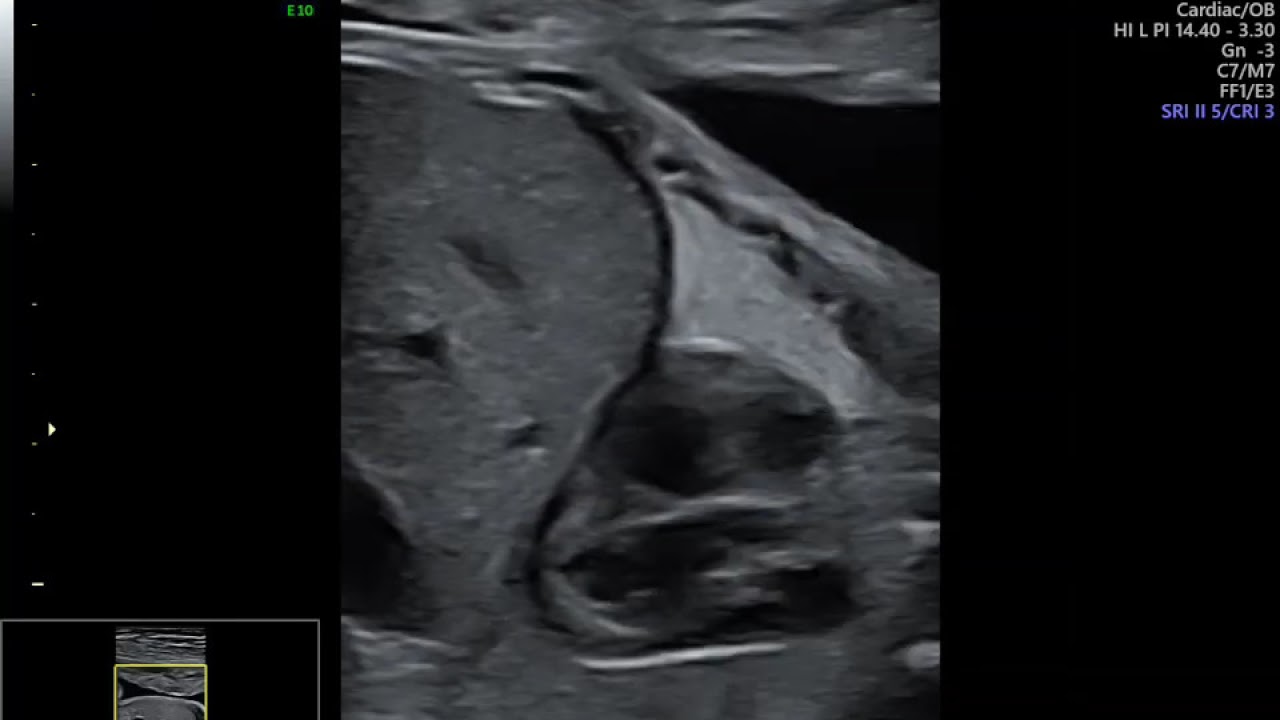 ULTRASSON MORFOLÓGICO