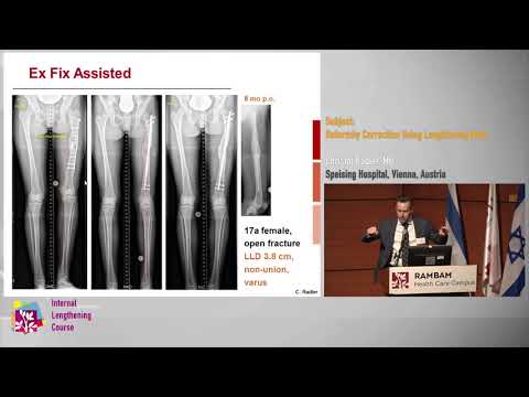 4 Deformity Correction Using Lengthening Nails - Christof Radler MD.