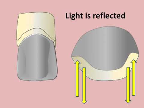 Framework Design for the Porcelain-Veneered Restoration
