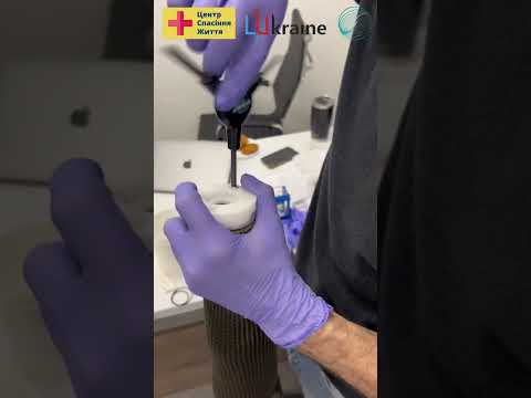 Протезування за допомогою технології Direct Socket від OSSUR