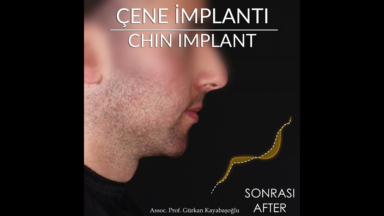 Dr Gurkan Kayabasouglu Plasti Surgeon in Istanbul, Turkey-  Rhinoplasty and Chin Implant