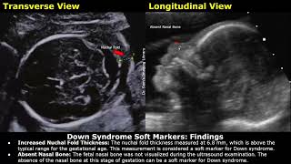 Down Syndrome Soft Markers Fetal Ultrasound Report Example | Trisomy 21 Aneuploidy Obstetric USG