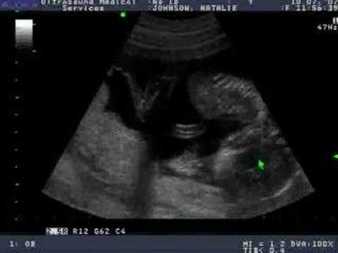 We're Having a Girl!