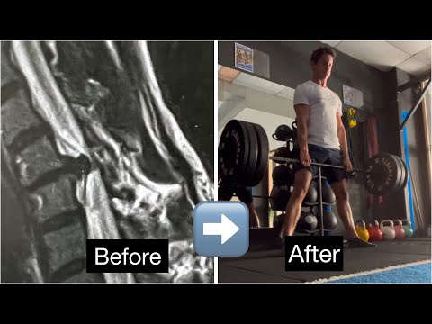 From Neck Herniated Disc to Deadlifting 100+kg - NO SURGERY