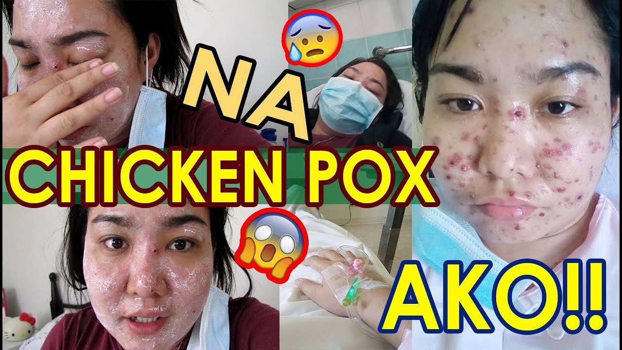 ANG CHAKA!! MY CHICKENPOX EXPERIENCE VLOG #8 (Bacolodnon) | jaygee