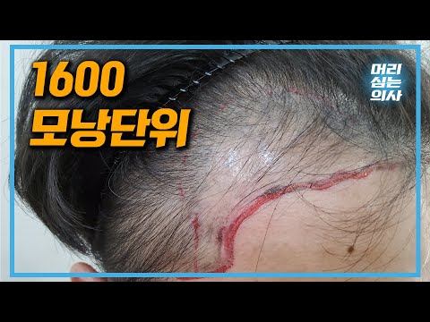 비절개 모발이식 1600모낭 8개월 경과